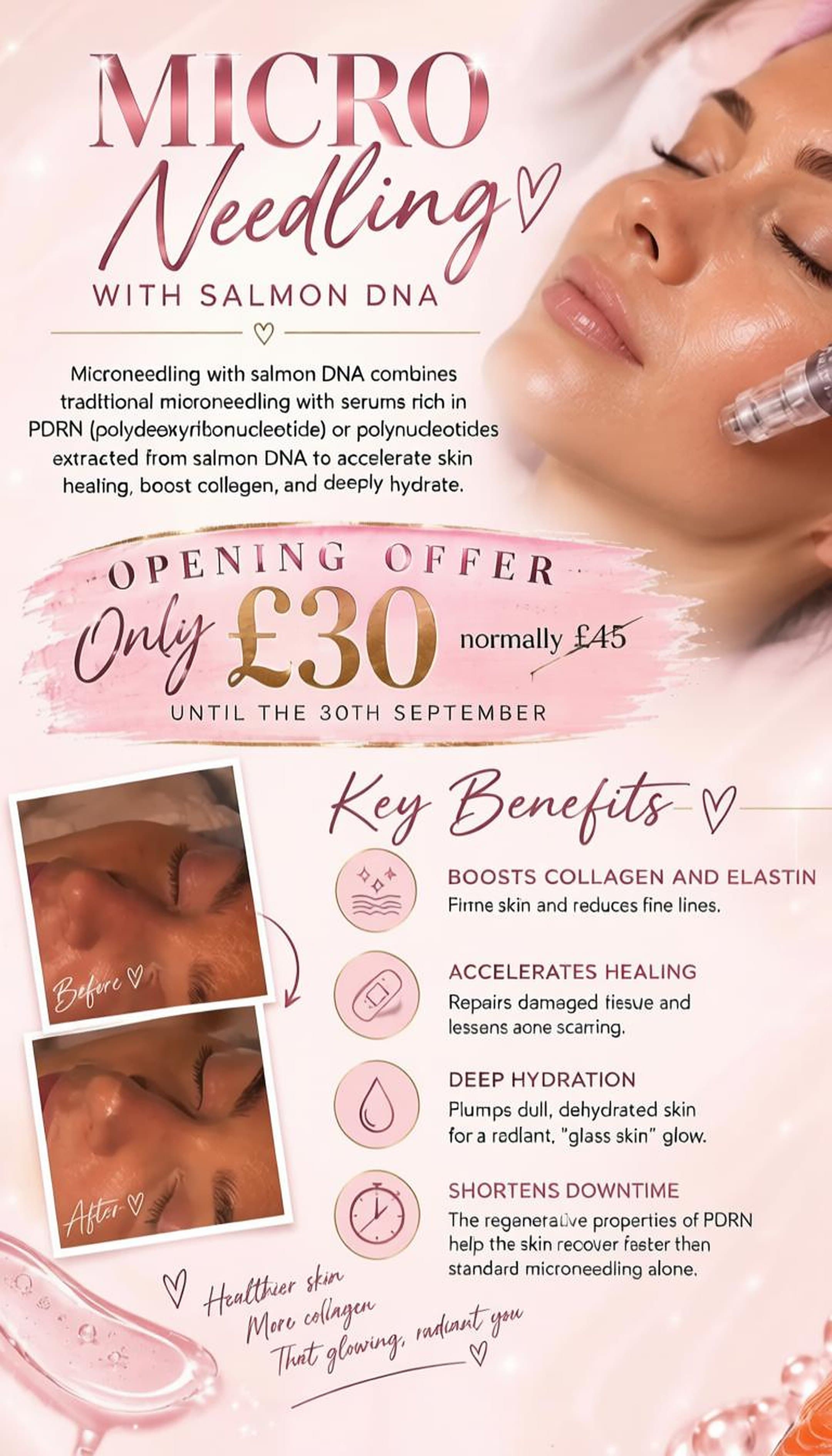 Micro-Needling with Salmon DNA treatment flyer